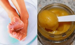 nail fungus folk remedies